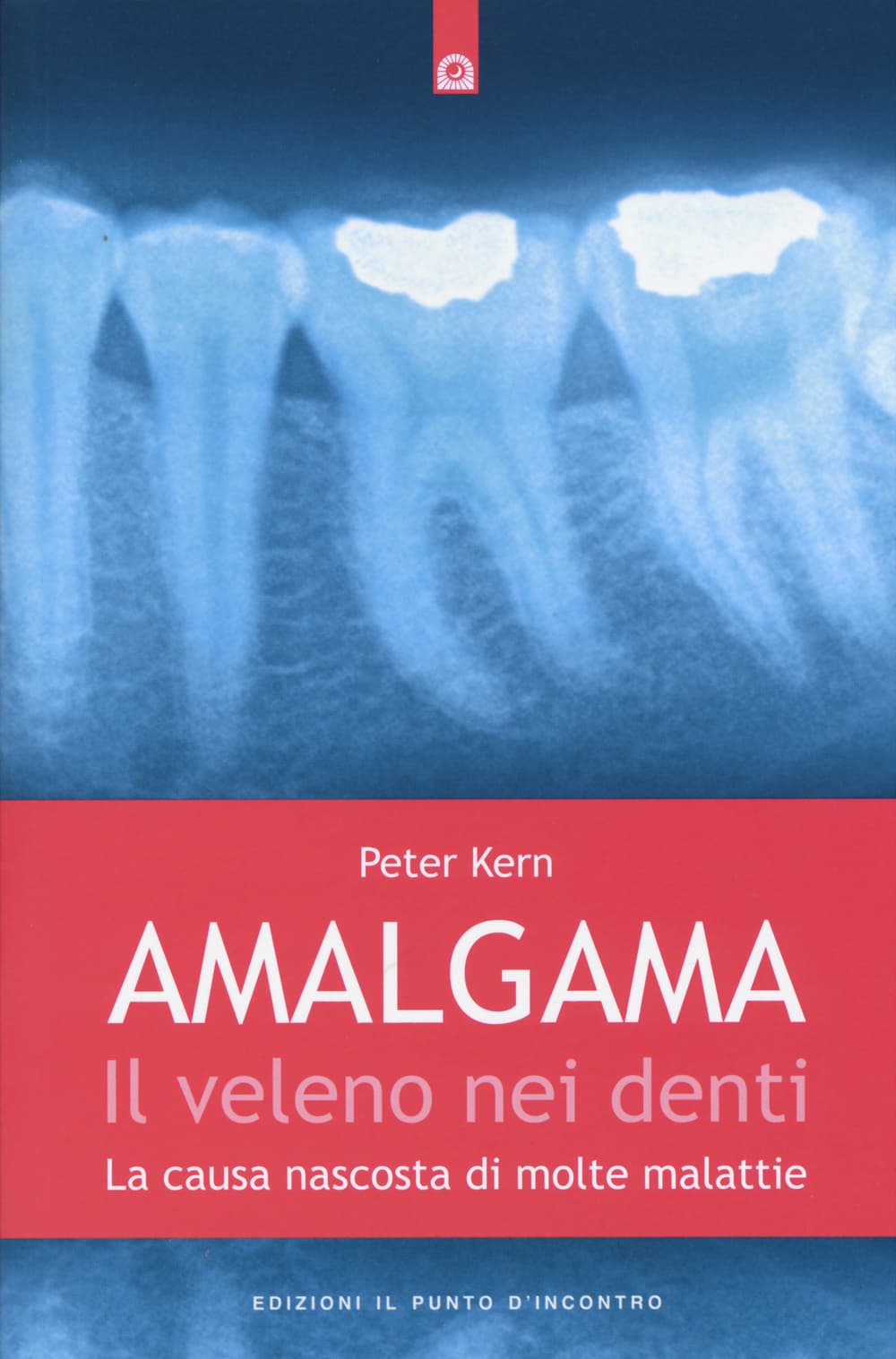 Amalgama. Il veleno nei denti. La causa nascosta di molte malattie